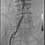 Right common iliac artery stenosis.