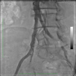Post common iliac artery stenting stenosis.