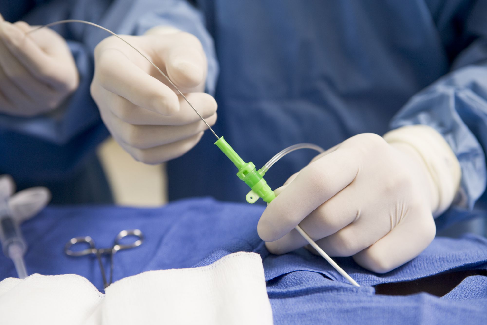 varicoza care a facut minifactomie