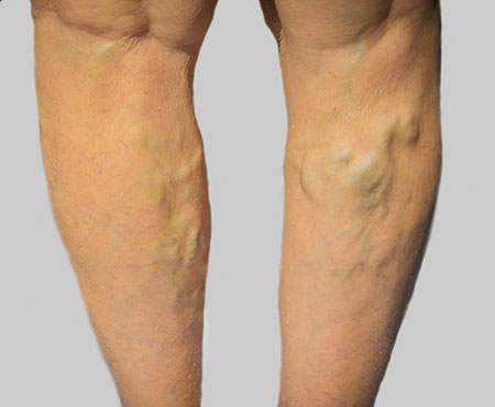 varicose-veins