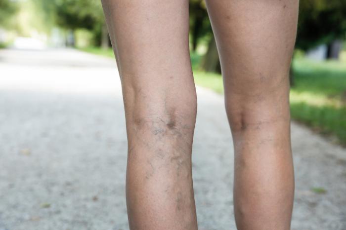 Varice ideas | sănătate, varice, remedii naturale
