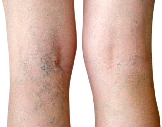 Indian Vascular Surgery
