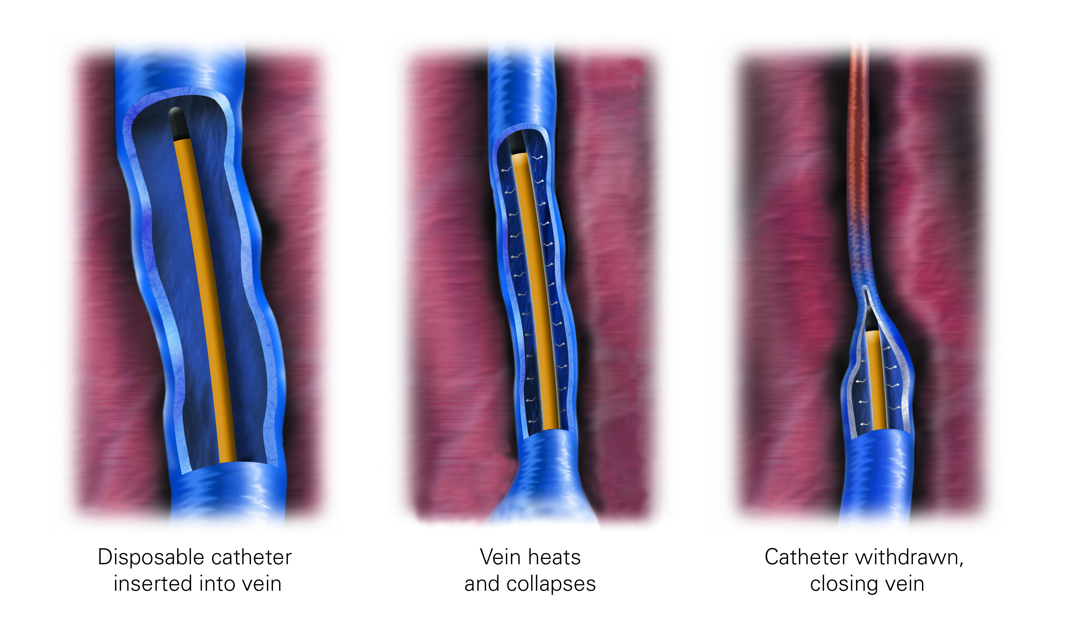 Indian Vascular Surgery