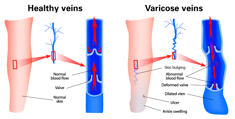 Indian Vascular Surgery